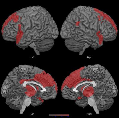 Reduced phonemic fluency in progressive supranuclear palsy is due to dysfunction of dominant BA6